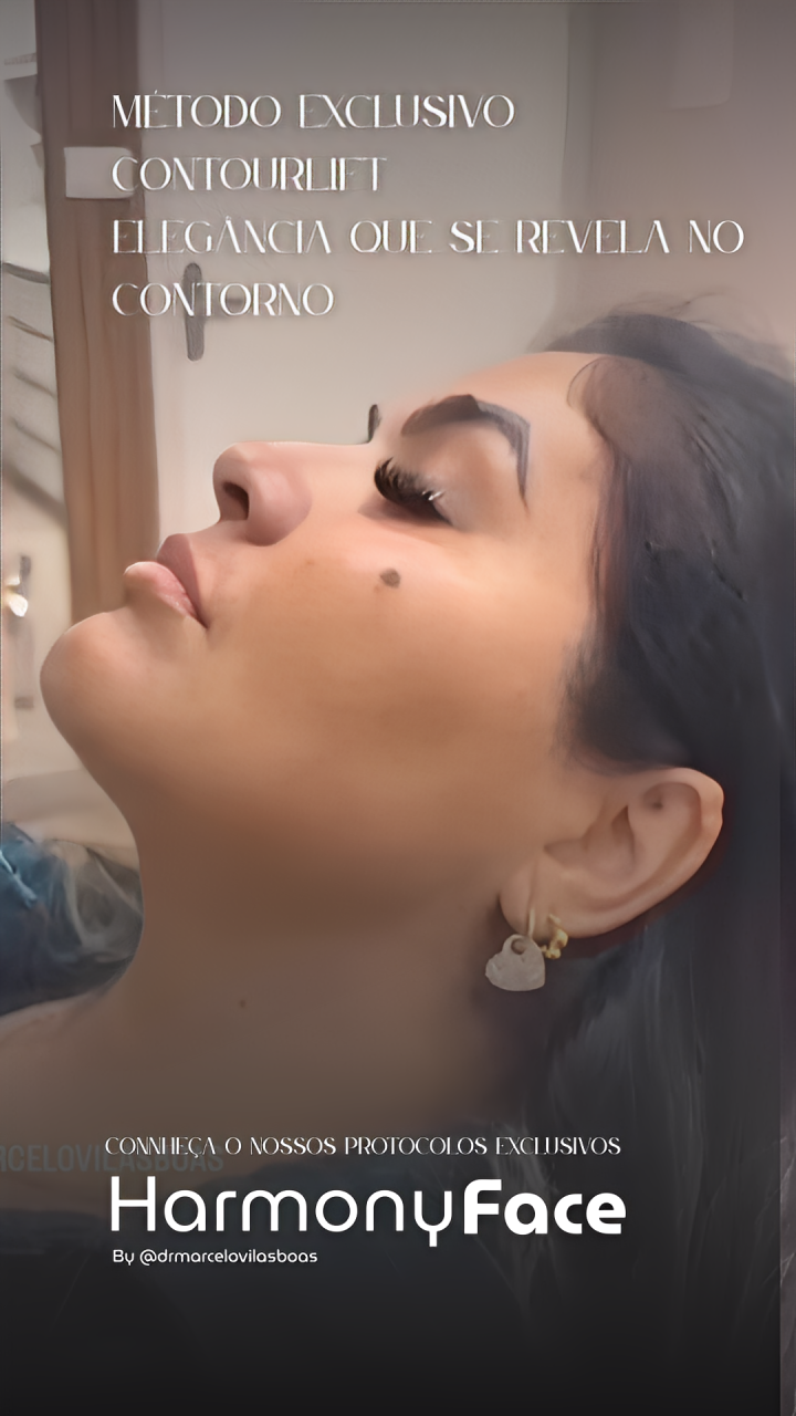 Harmonização Facial Natural - HarmonyFace Londrina Norte Pioneiro